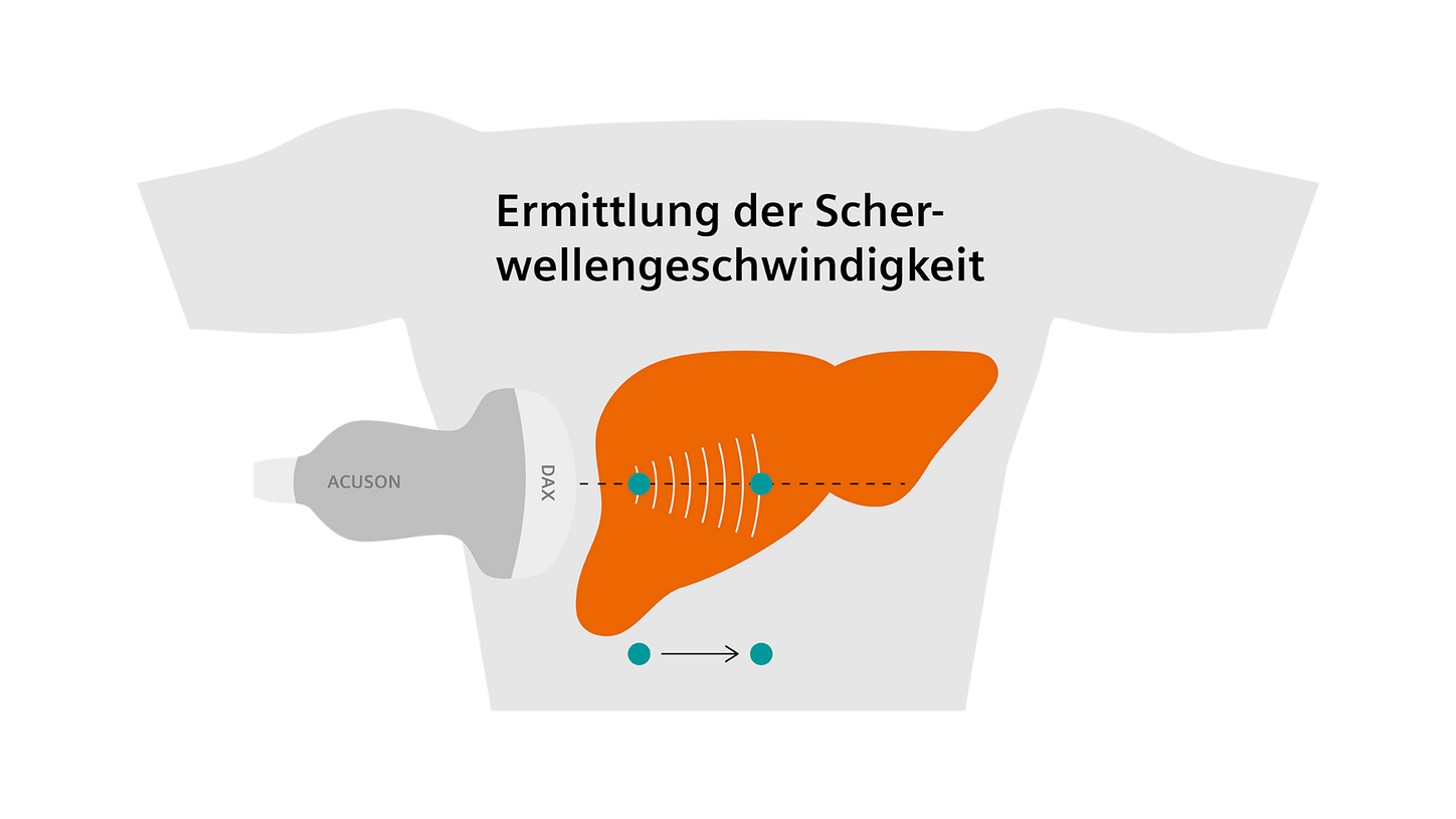Scherwellen-Elastographie der Leber