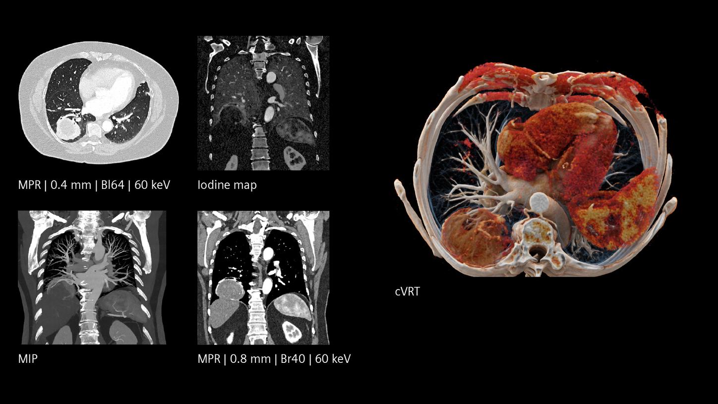 Thoracic pathology with high level of detail
