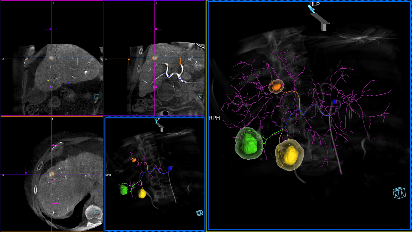 Transarterial chemoembolization of multiple liver tumors