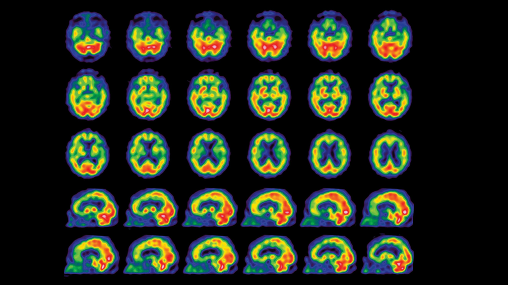 Beta-amyloid PET/CT imaging for Alzheimer's disease - Siemens ...
