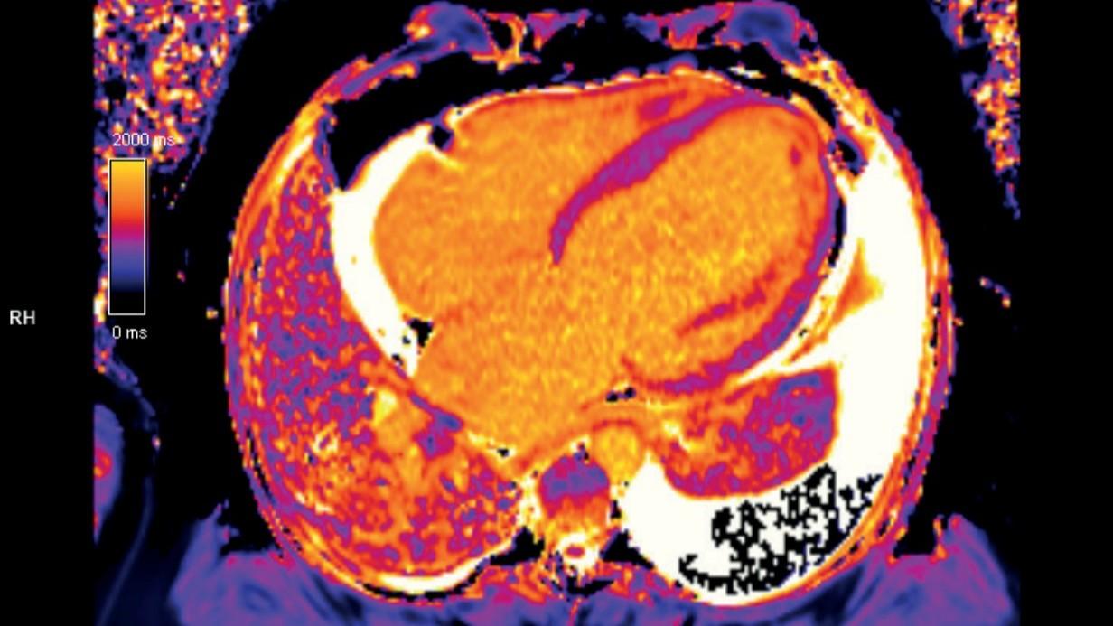 Kardiologiczny Rezonans Magnetyczny Serca