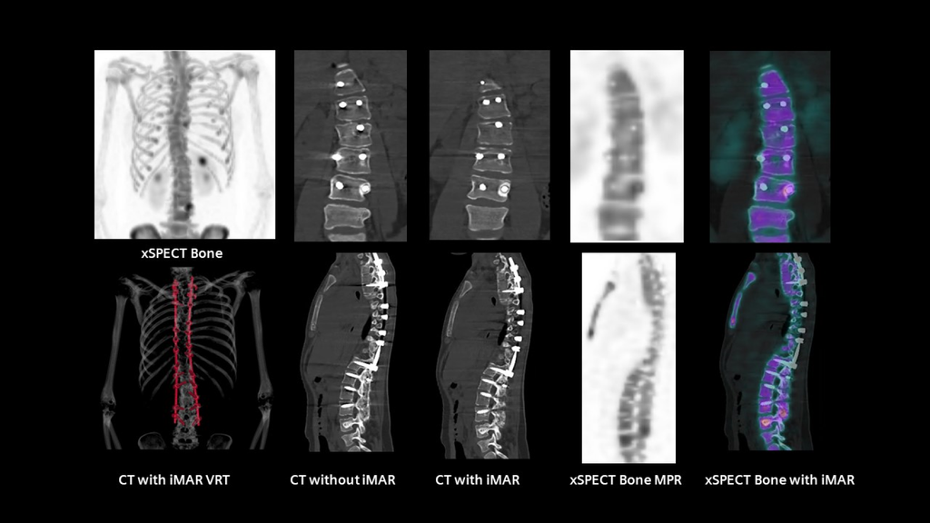 SPECT/CT in musculoskeletal medicine - Siemens Healthineers