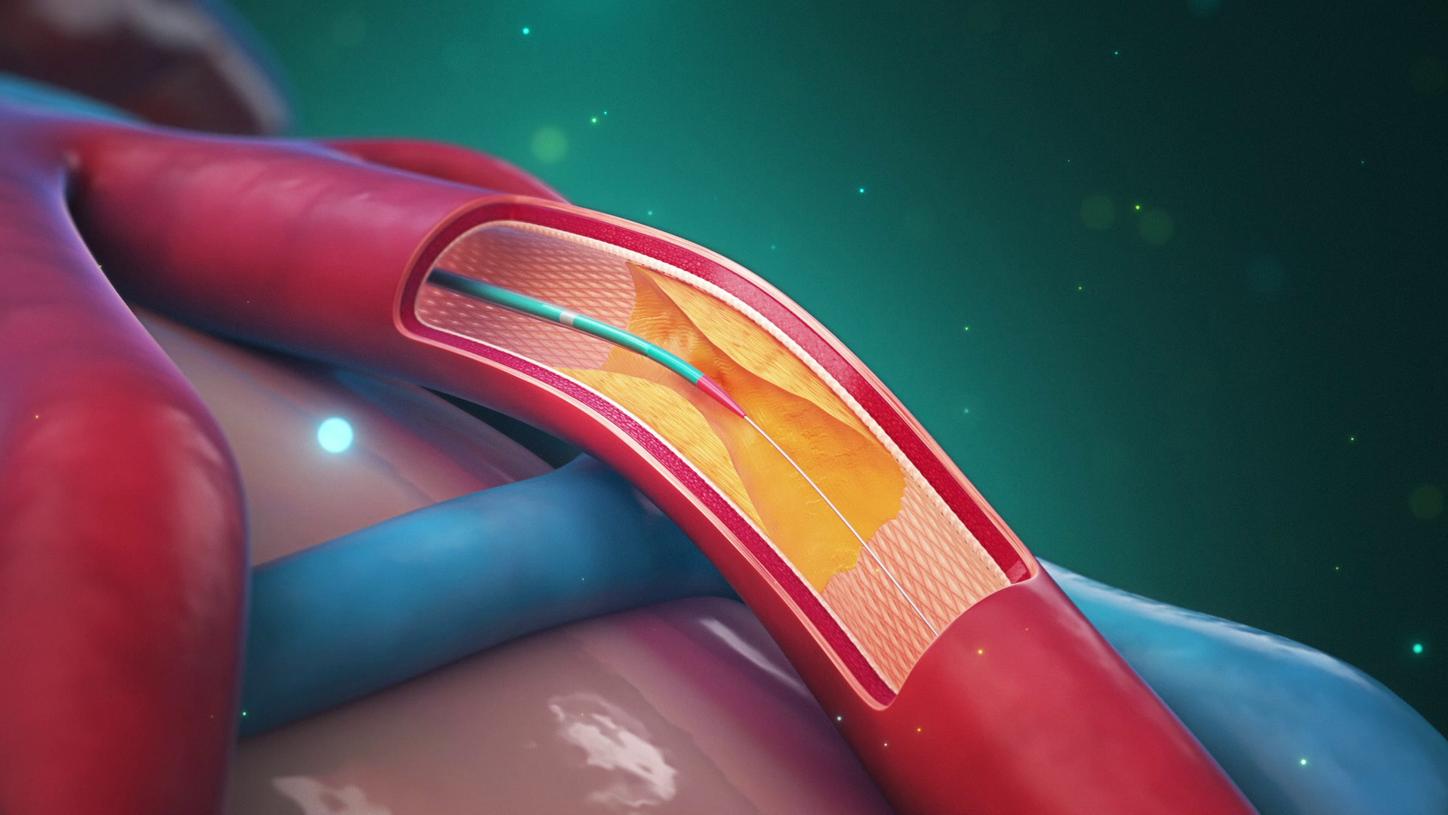 Erweiterte Präzision mit Corindus CorPath GRX