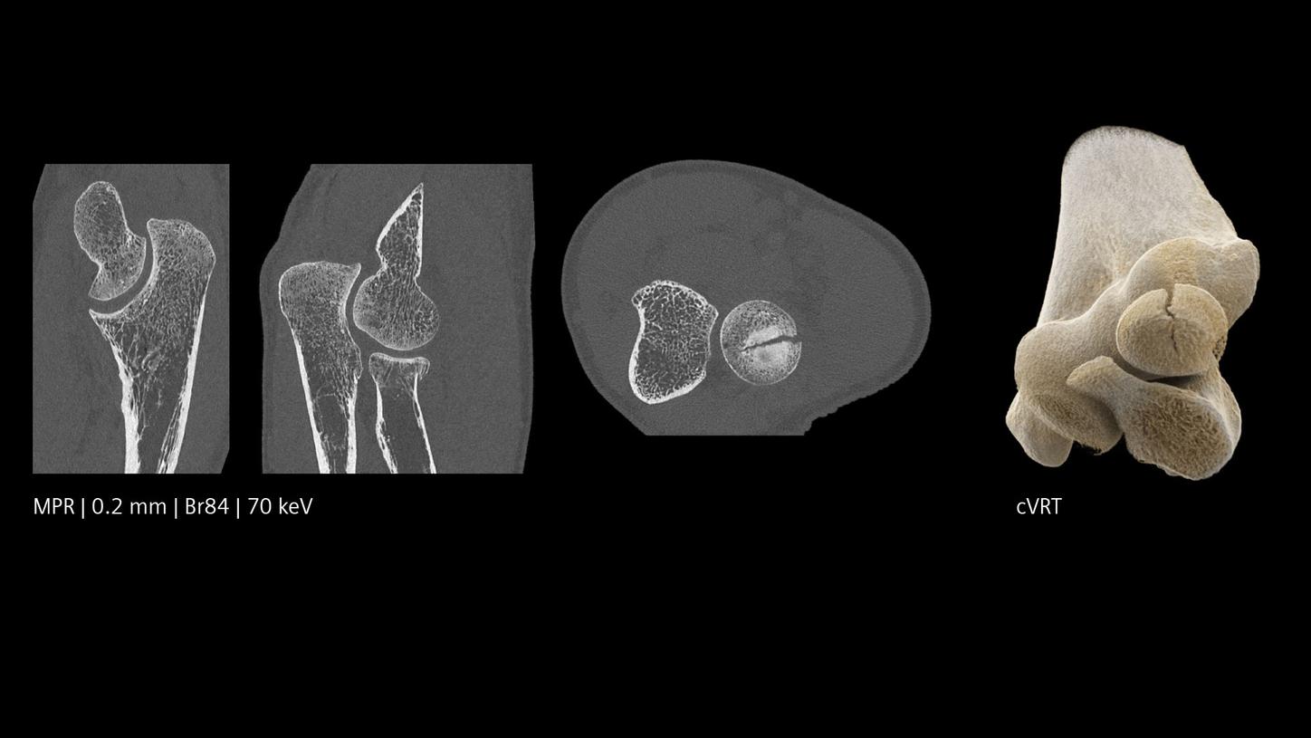 Quantum HD image of an elbow-caput radii fracture
