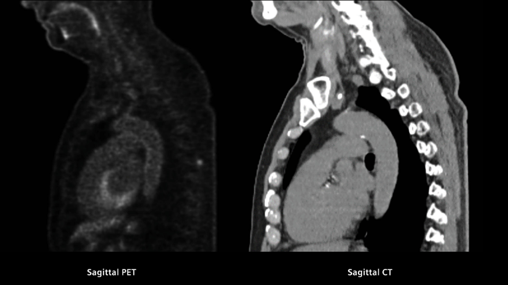 Biograph Vision clinical case