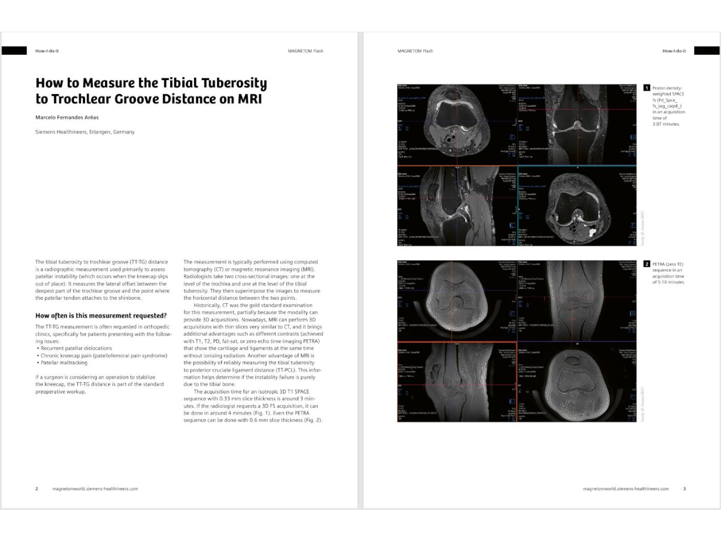 siemens-healthineers_magnetomworld_tibial-tuberosity