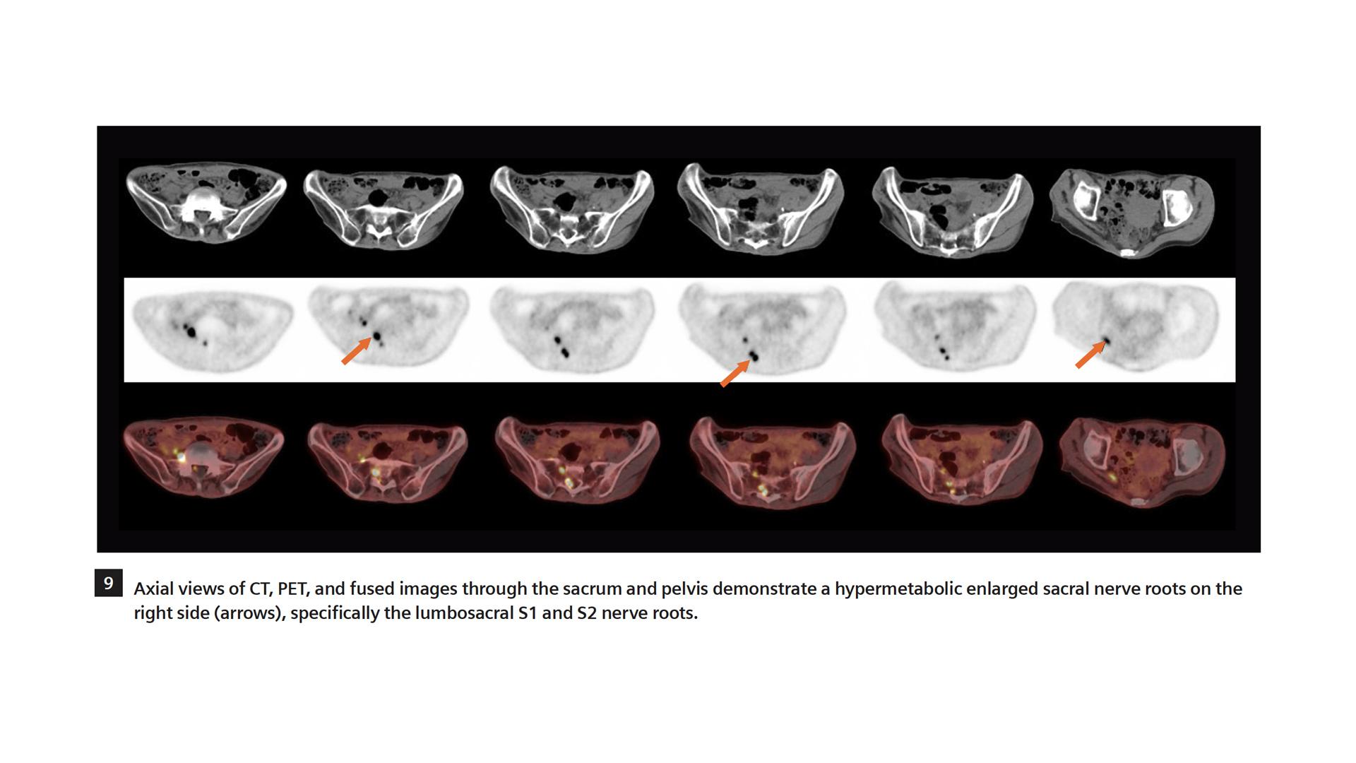 18F FDG PET/CT delineation of diffuse large B-cell lymphoma involving ...