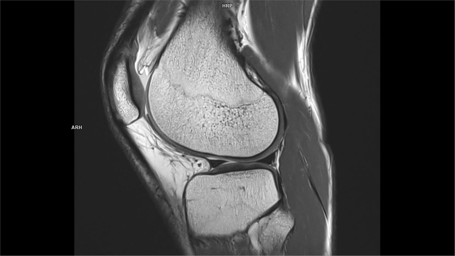 Sagittal PD tse DR Sharp-MAGNETOM Vida/Coil-Knee 18/Resolution-800/Scan Time-1:33/Aceleration-p3 DR