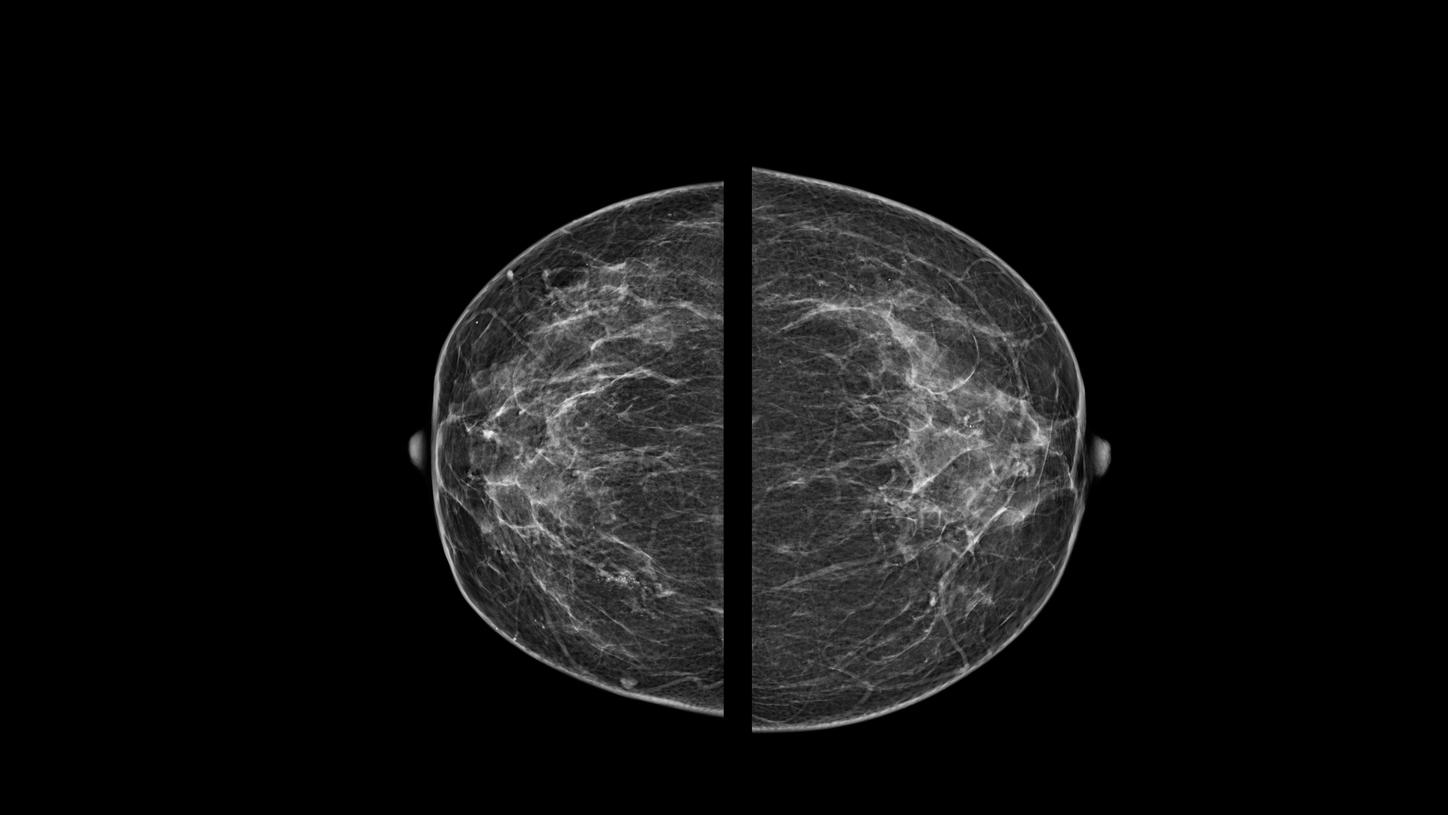 mamografia-bilateral-de-rastreio-2