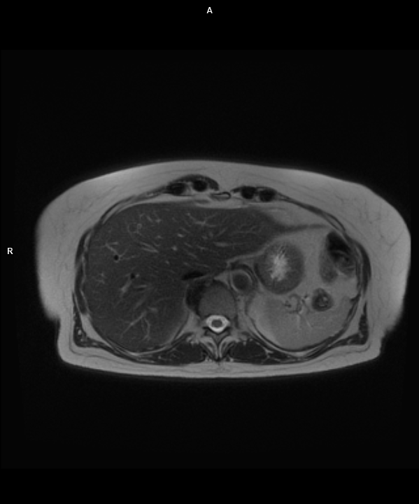 Axial T2 Blade RT-MAGNETOM Free.Max/Coil-BM Contour Large/Spine/Resolution-320/Scan Time-2:10/Aceleration-p2