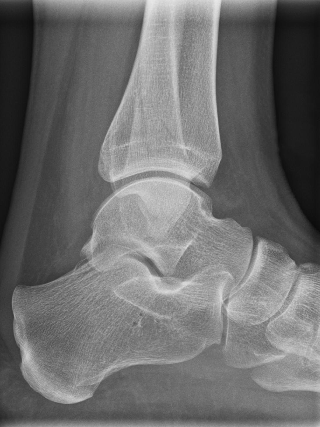 X-ray of an ankle