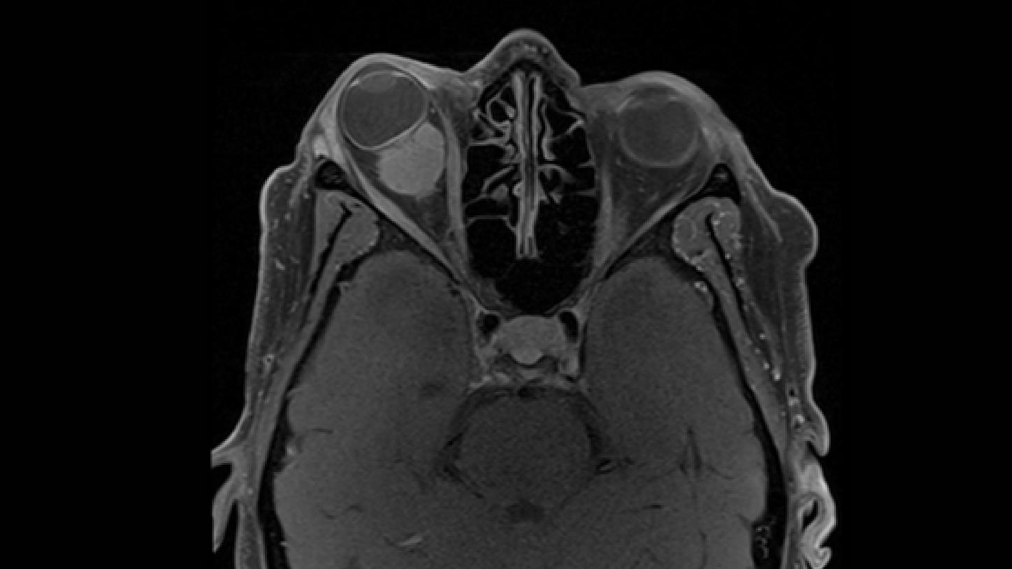 meningioma óptico