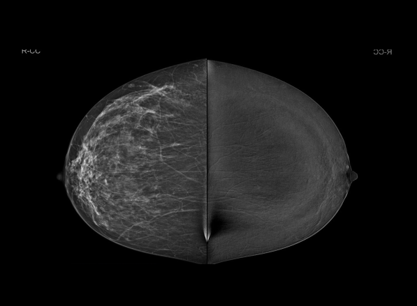 Right breast