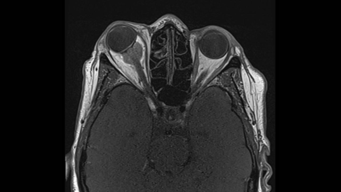meningioma óptico