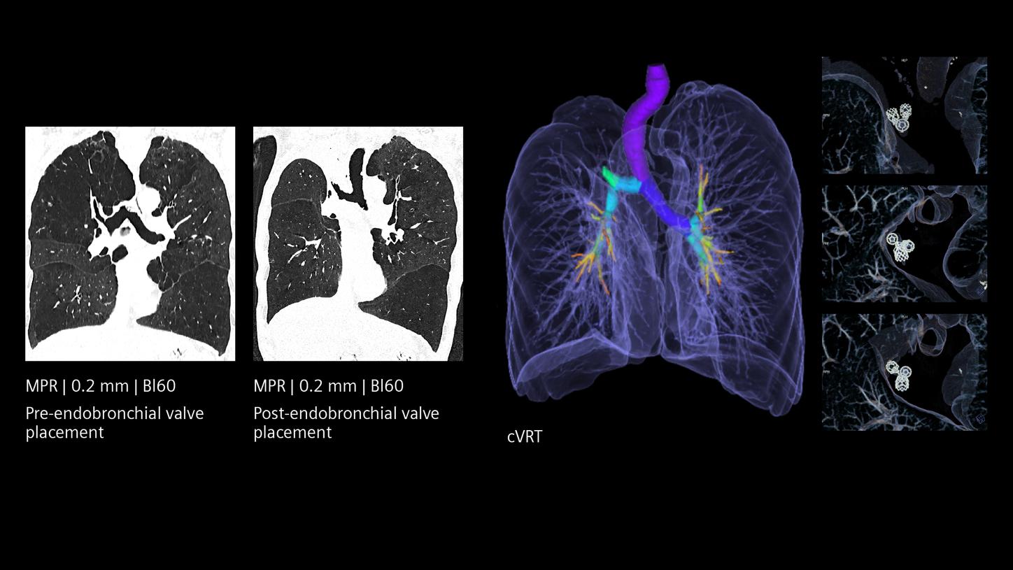 Clinical Quantum HD images of pre- and post-endobronchial valve treatment.
