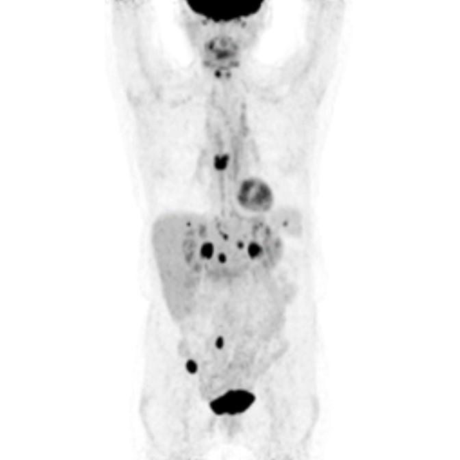 Oncology Indications Ovarian