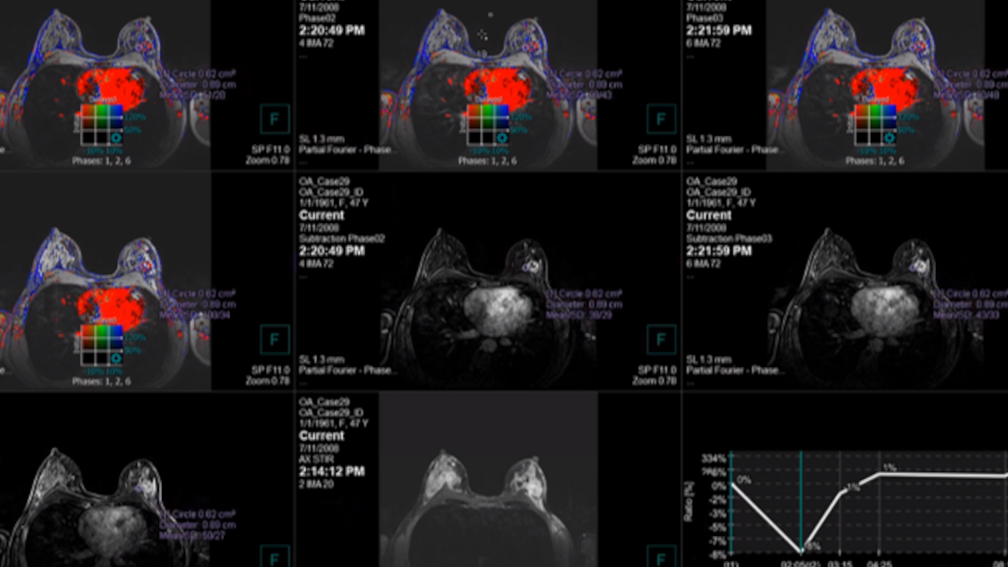 MAMMOVISTA B.smart: erweiterte Diagnose auf einen Blick verfügbar.