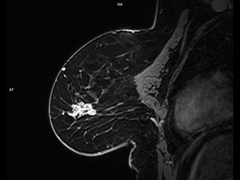 Sagittal T1 3D Dixon-MAGNETOM Lumina/Coil-Breast 18/Resolution-768/Scan Time-3:48