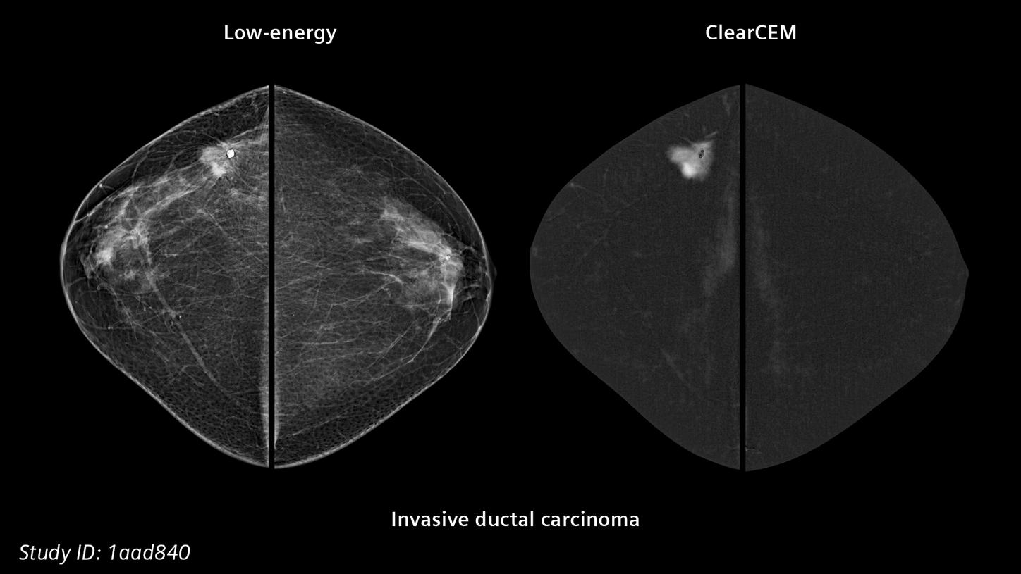 Lesion Detection in Mammography with CLearCEM