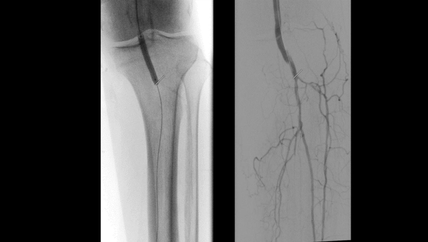The mobile C-arm machine Cios Alpha.neo: Mobile 2D imaging for vascular surgery