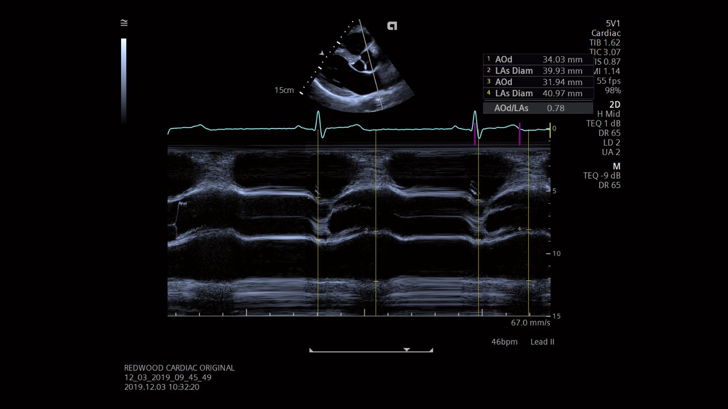 Ultrasound Cardiac M MODE AT AO/LA