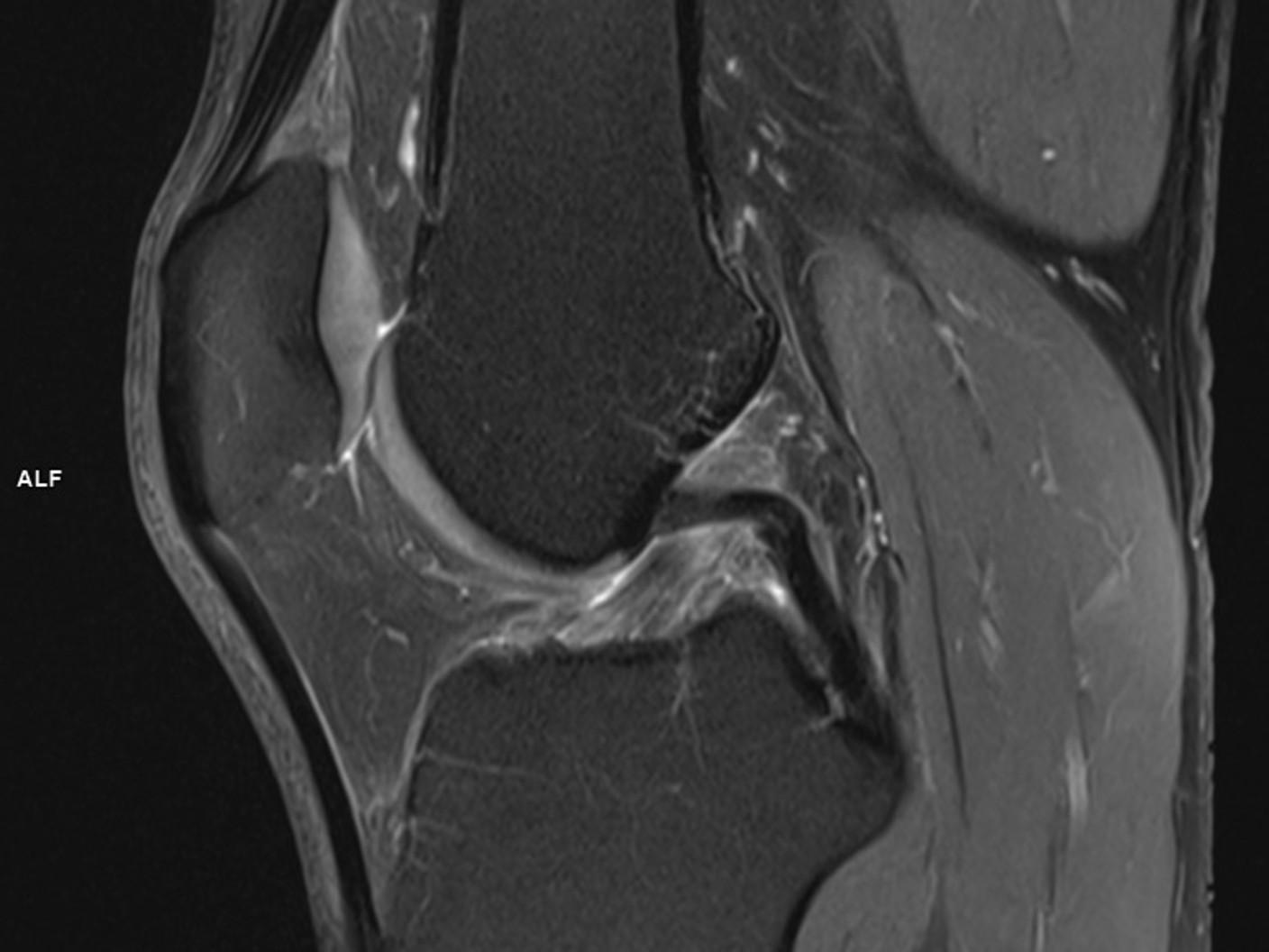 SAGITTAL PD FS TSE-MAGNETOM Vida