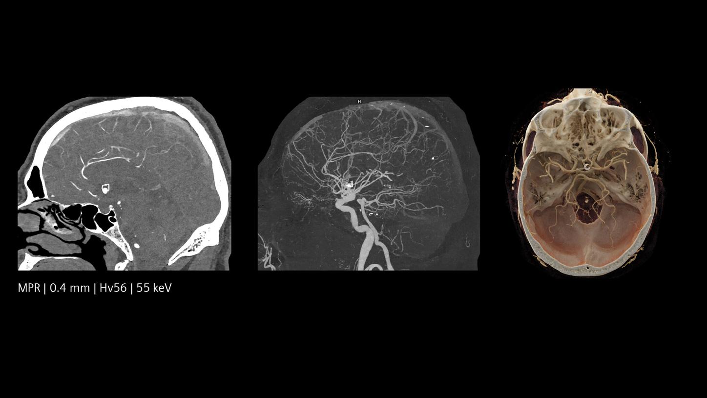 Cerebral CTA follow-up after an intervention.