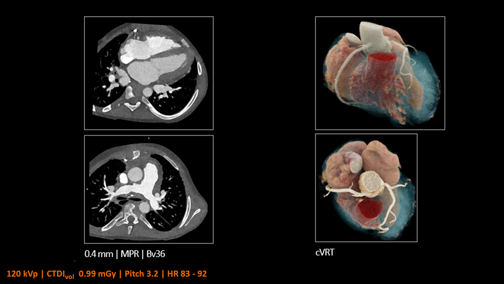 Dual Source CT - Siemens Healthineers