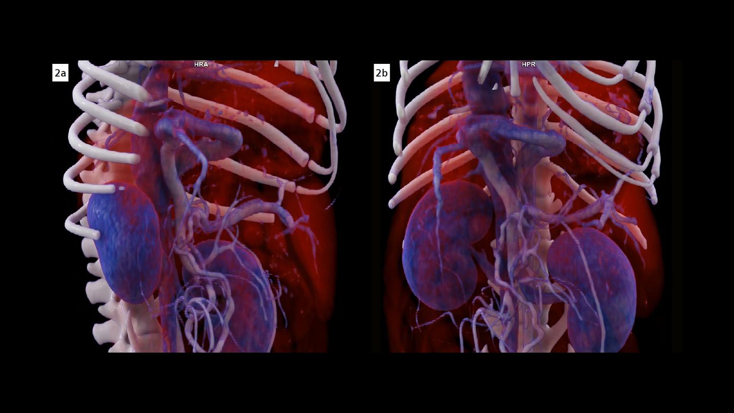 Two VRT images show the origin, the course and the draining location of the portocaval shunt in three dimensions.