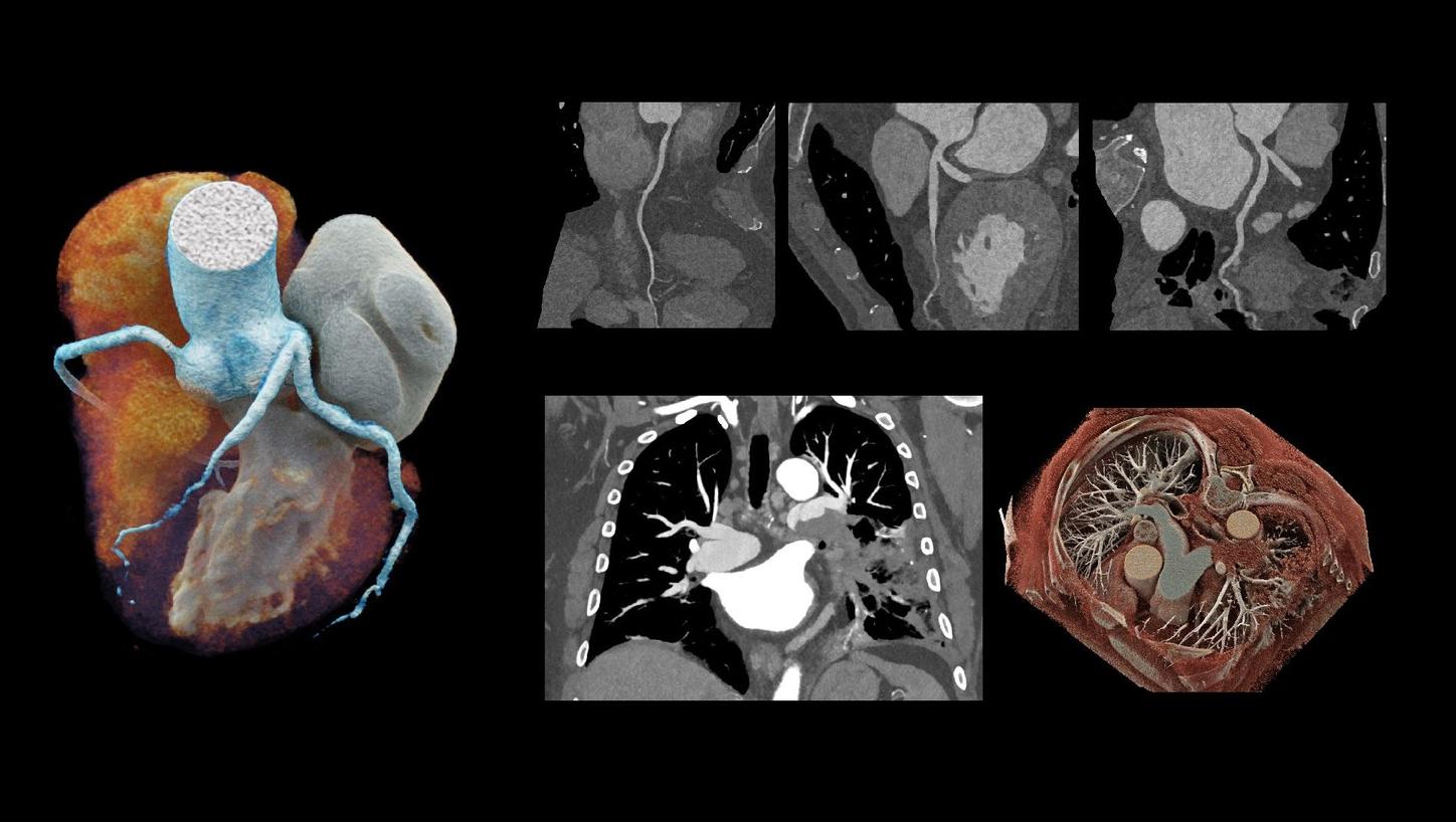 Triple-rule-out evaluation of acute chest pain 