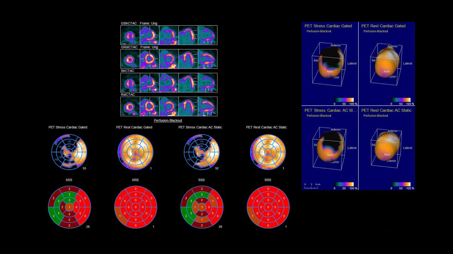 MPI summary of PET stress cardiac gated and PET rest cardiac gated.
