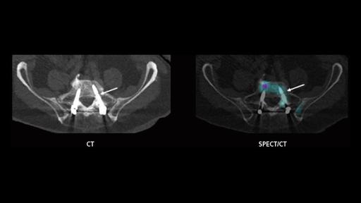 SPECT/CT imaging in the evaluation of pain following spinal fusion ...