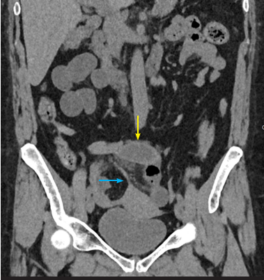 coronal ct scan
