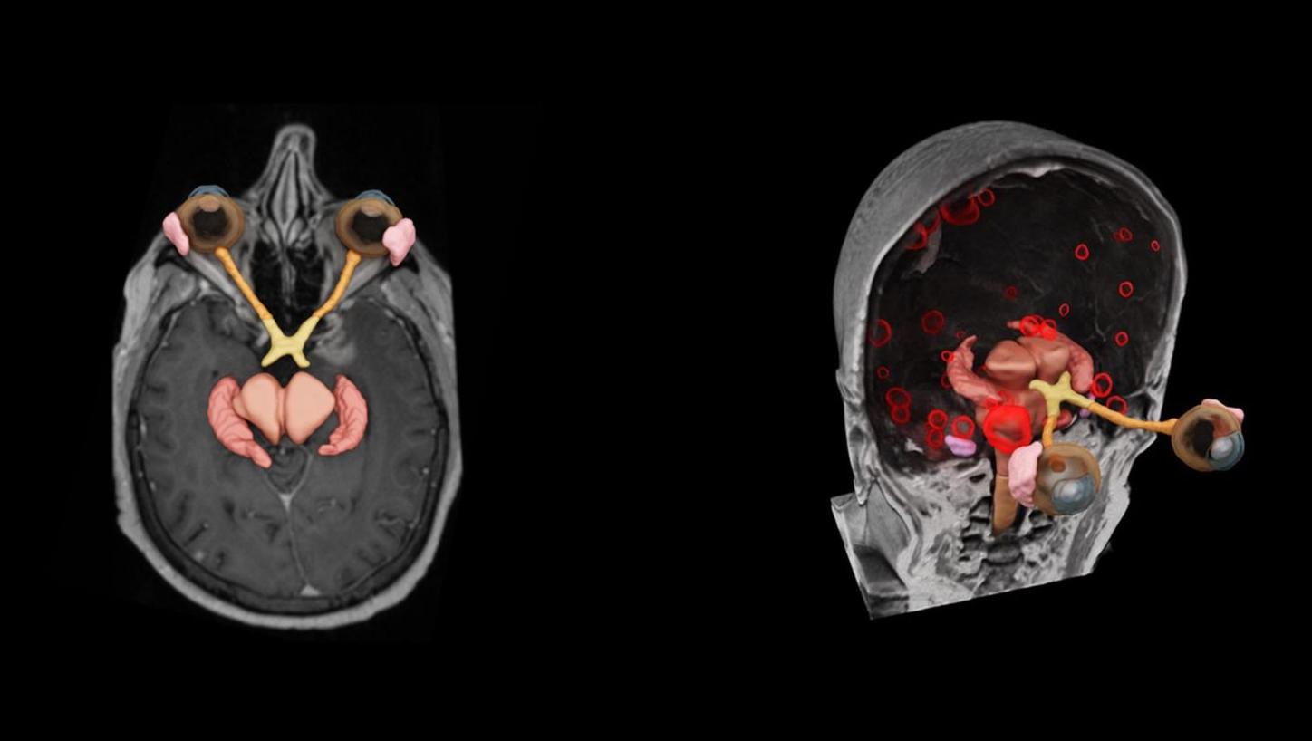 syngo.via RT Image Suite supports brain and pelvis OAR contouring and brain metastases contouring for MR data