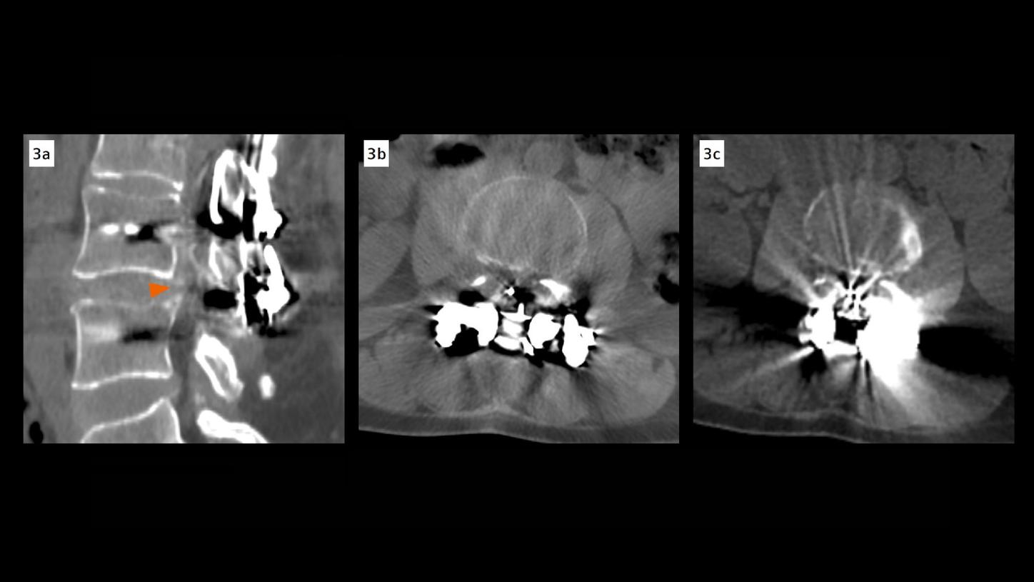 Three CT images of the lumbar spine at the L3–L4 level. A sagittal and axial image reconstructed using iterative metal artifact reduction combined with high-energy monoenergetic imaging at 140 keV. They show markedly improved visualization of the prosthetic components and surrounding anatomy, revealing moderate spinal canal stenosis. For comparison, an axial image acquired on a previous standard multislice CT scanner, with prominent metal artifacts that obscure the spinal canal and adjacent structures. 