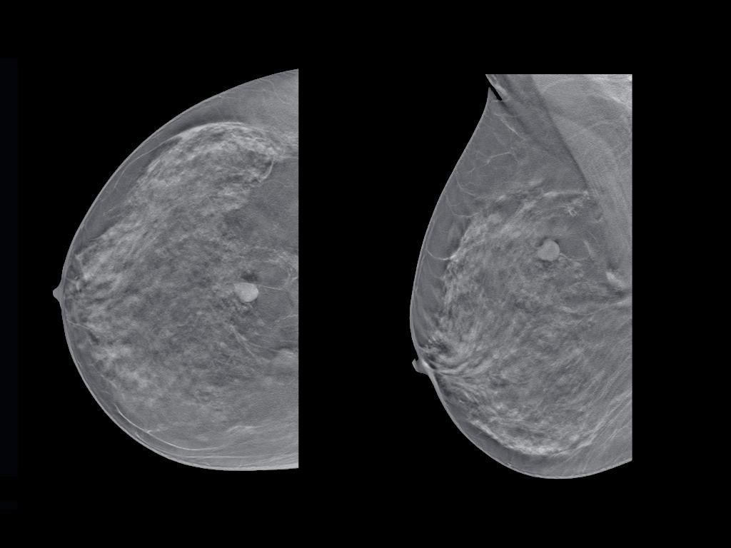 4-3-Carcinoma-lobular-00