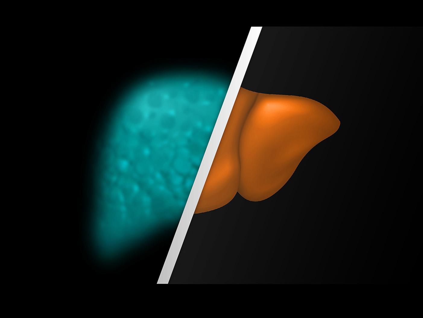 Management of MASLD Importance and Utility of the Enhanced Liver Fibrosis (ELF) test