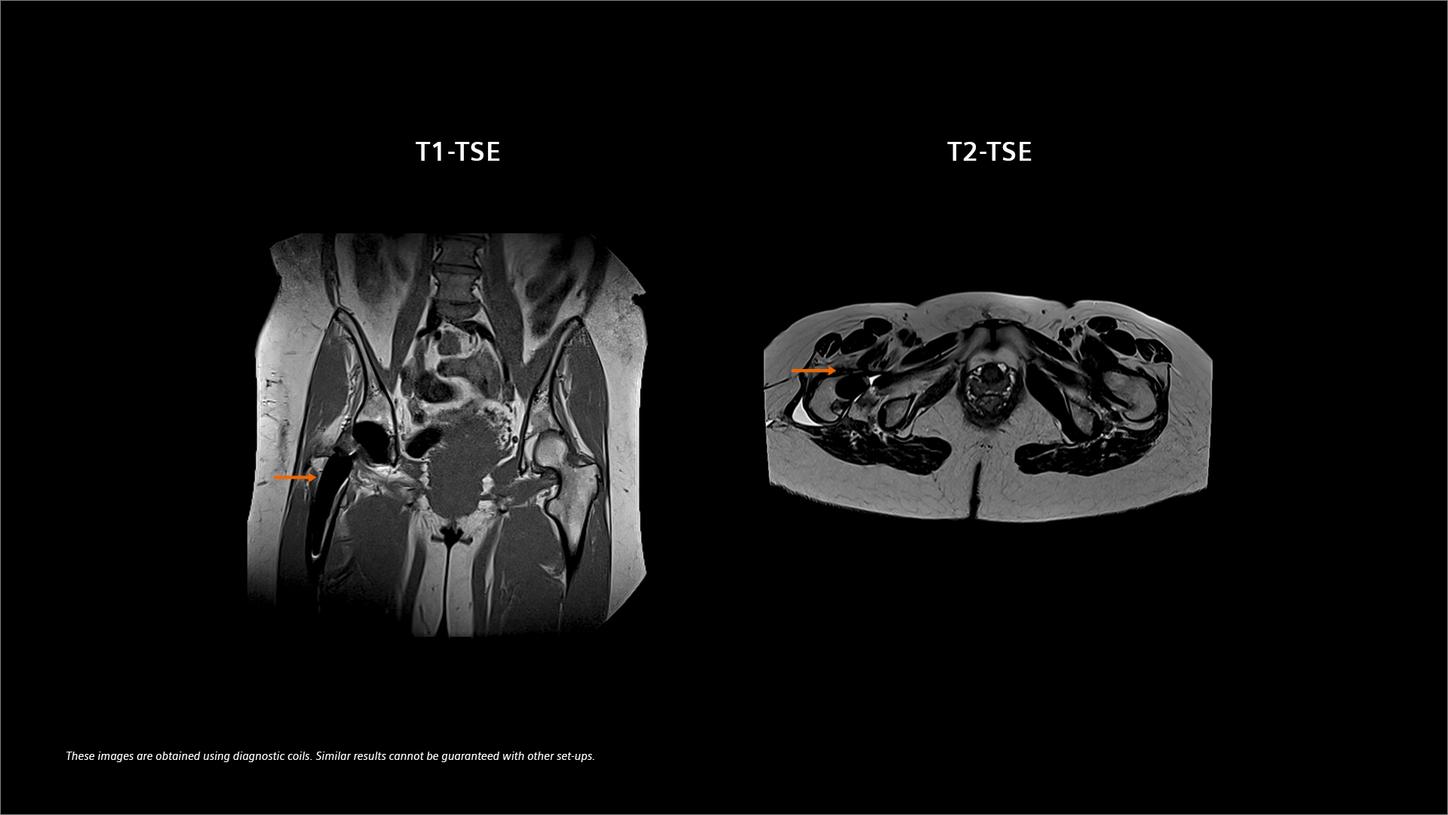 Low-field imaging reduces artifacts near metal implants