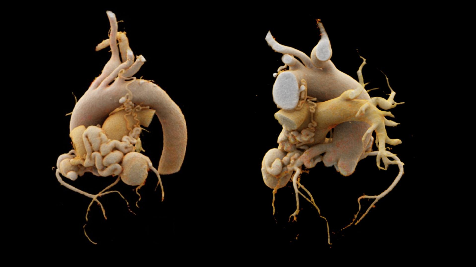 Complex coronary artery fistula Siemens Healthineers Türkiye