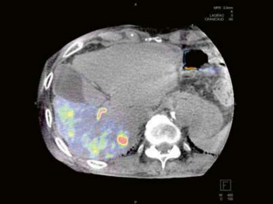 syngo dyna pbv study protocol