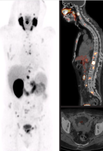Ga-PSMA PETCT scan (After 2 doses of Lu-PSMA)