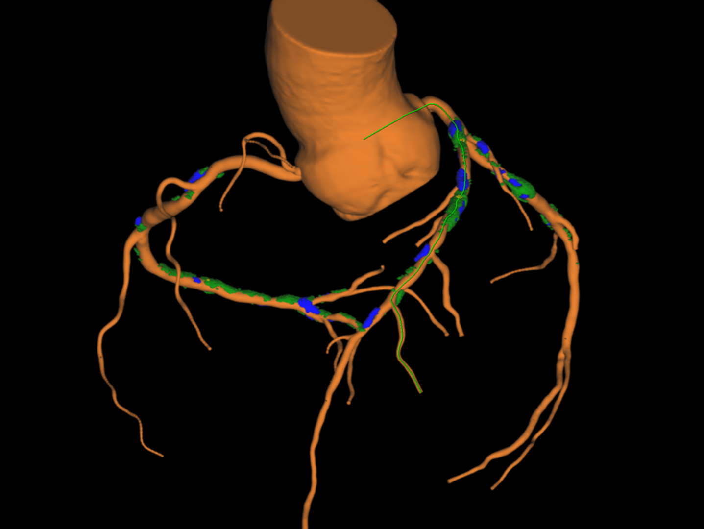 CT GUIDED PCI