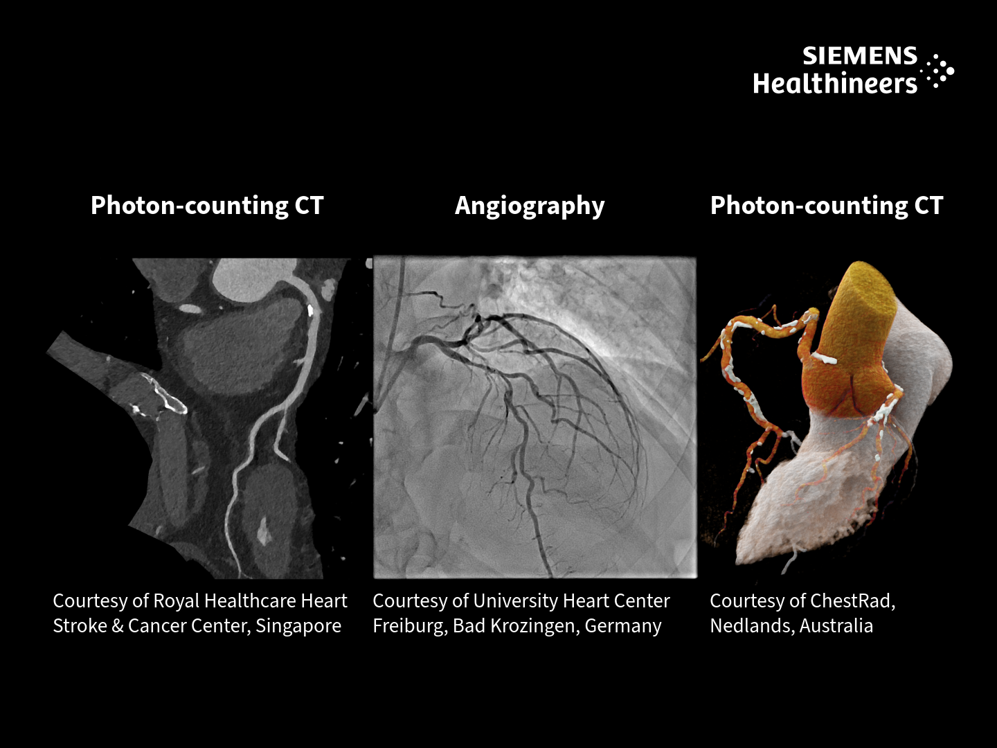 Plaque_Collage Menopause Photon-counting Angiography