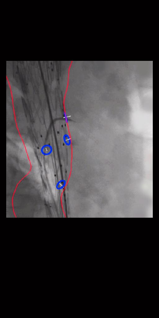 Clinical image showing overlay of anatomical landmarks from preparation step supporting in-catheter navigation