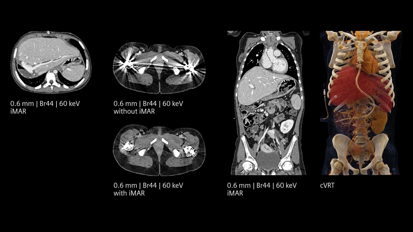 Pediatric oncology assessment displaying metal artefact acquired by a NAEOTOM Alpha photon-counting CT.
