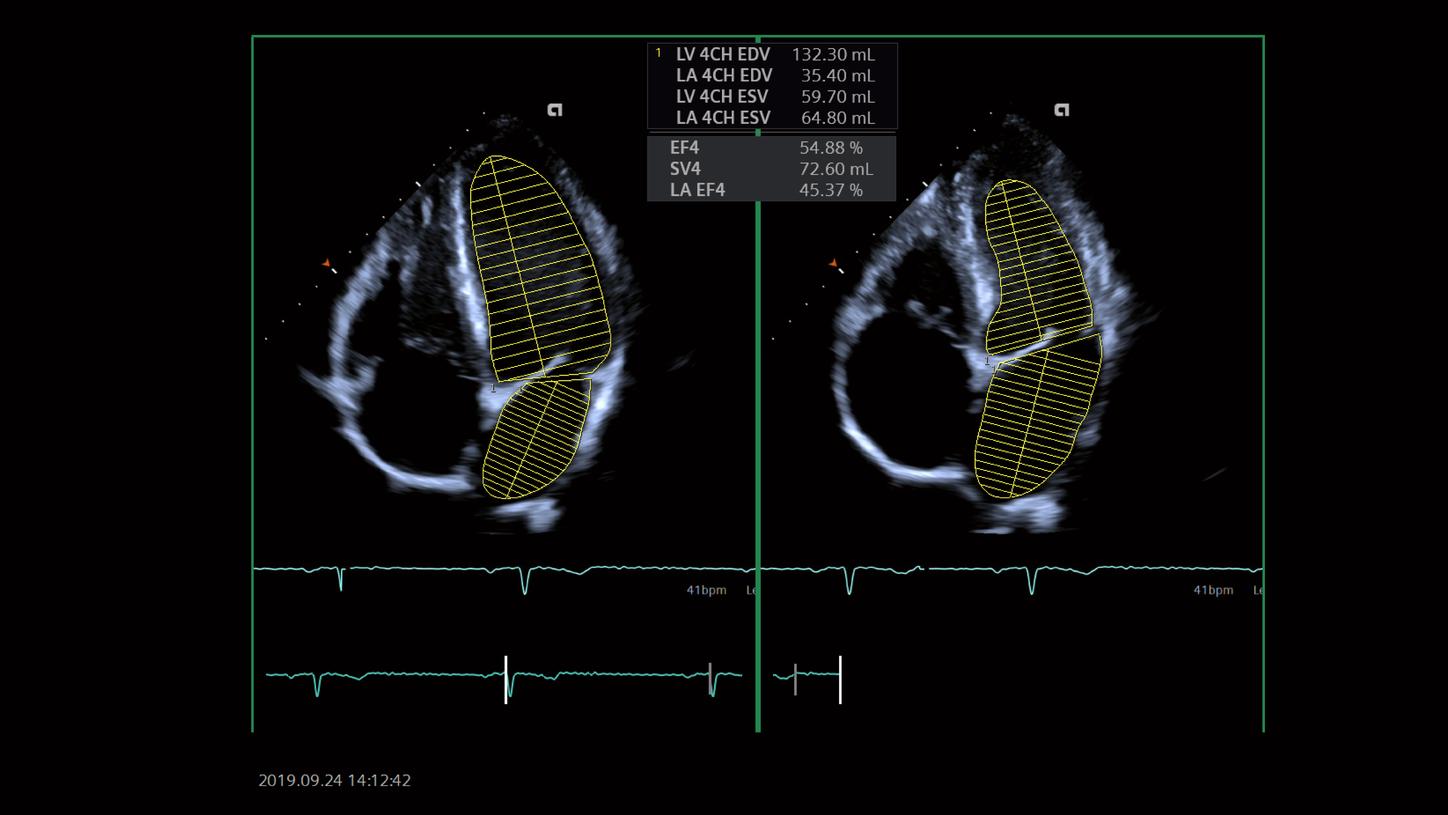 Improve efficiency and workflow with eSie Left Heart