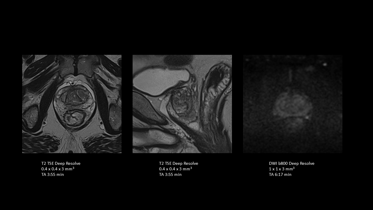Small FOV prostate imaging