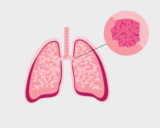 Squamous cell cacrinoma