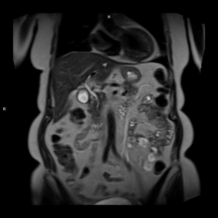 Coronal T2 BH-MAGNETOM Free.Max/Coil-BM Contour Large/Spine/Resolution-272/Scan Time-0:11/Aceleration-p2