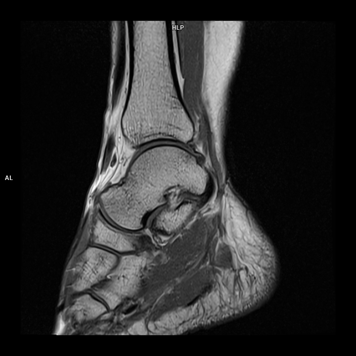 Sagittal T1-MAGNETOM Free.Max/Coil-Contour Small/Resolution-576/Scan Time-2:07/Aceleration-p2 s2 DRS